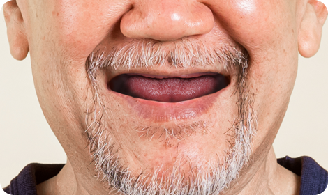 denture